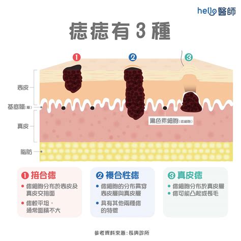 身體痣|痣形成的原因？痣長毛、痣變多變大是痣病變？5招判。